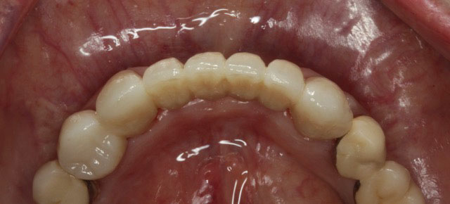 after fixed partial dentures 1