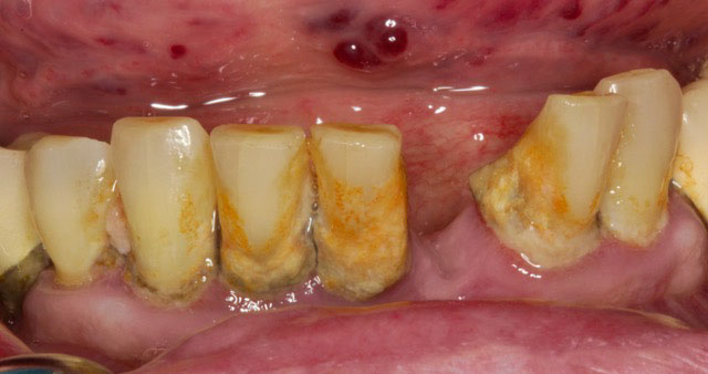 before fixed partial dentures 2