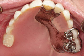 maxillary-obturator-implant-in-mouth